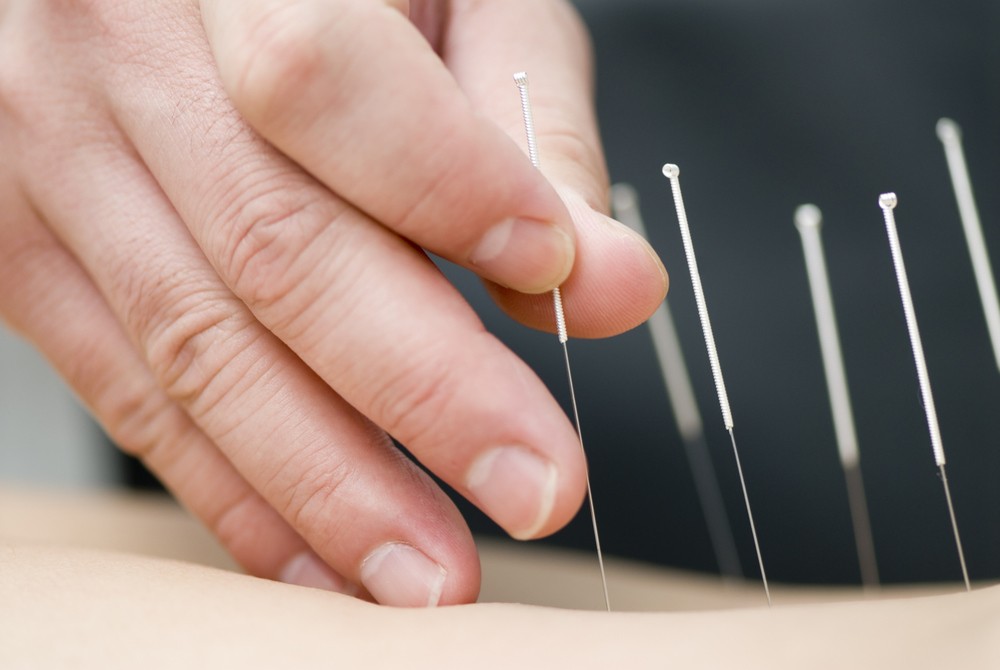 طب سوزنی مهم‌ ترین شاخه طب‌ سنتی چینی