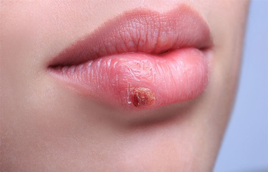 چگونه از تبخال پیشگیری می کنید؟ | نکات پیشگیری