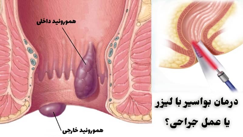  درمان بواسیر یا هموروئید با لیزر و عمل جراحی به صورت سرپایی در کمتر از نیم ساعت