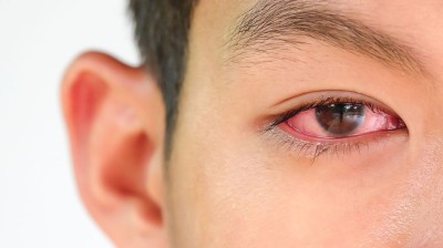 چه کمبودی باعث ایجاد چشم صورتی می شود؟